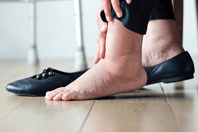 Can Opioids Cause Swelling of Feet and Ankles? A Detailed Look